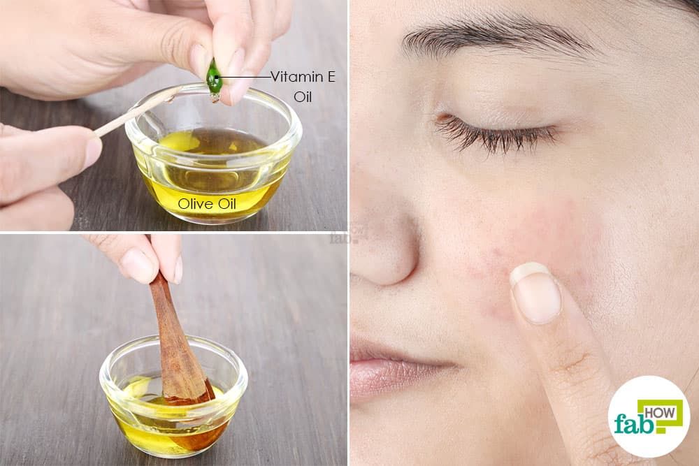 vitamin e oil skin treatment